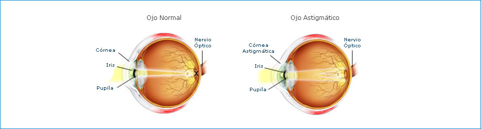 Astigmatismo