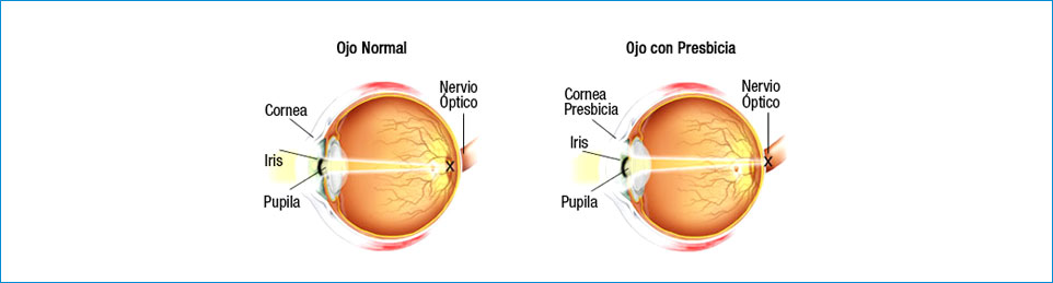 Presbicia o vista cansada