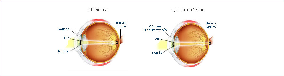 Hipermetropía
